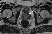    MRI in prostate cancer(Review)
